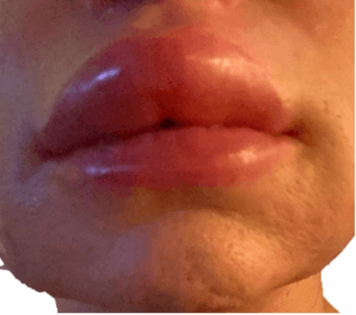 Angioedema due to the injection of hyaluronic acid.