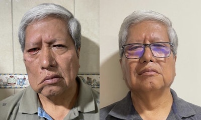 Patient before (left) and after treatment for facial nerve paralysis.