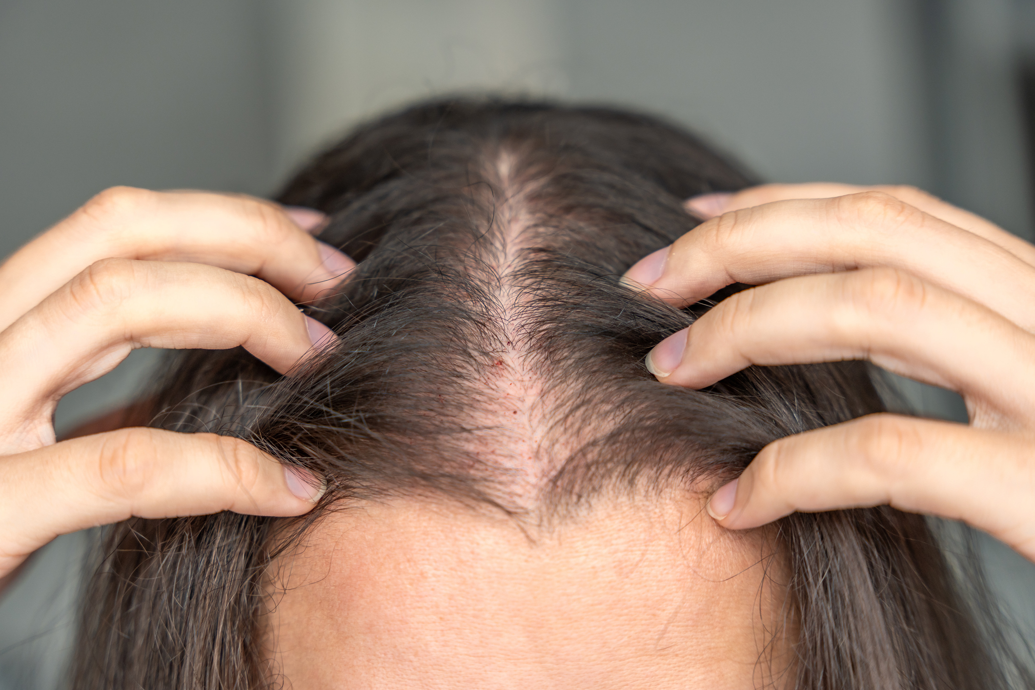 Hair Disorders Alopecia Treatment