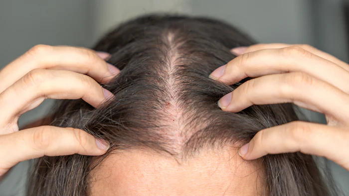 Hair Disorders Alopecia Treatment