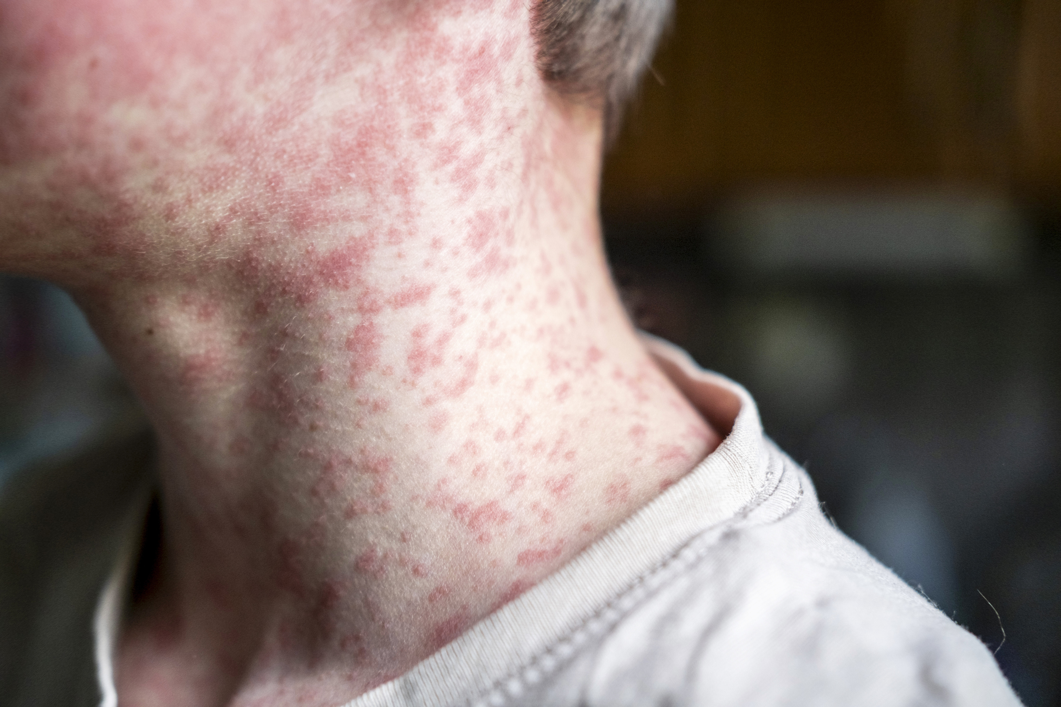 Close-up of neck and chest showing pink rash or skin irritation on pale skin