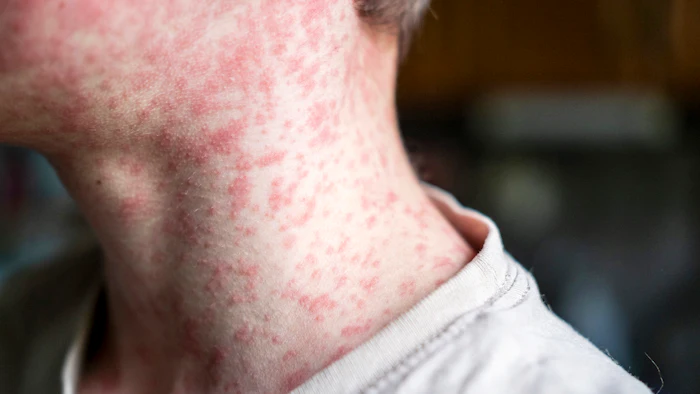 Close-up of neck and chest showing pink rash or skin irritation on pale skin