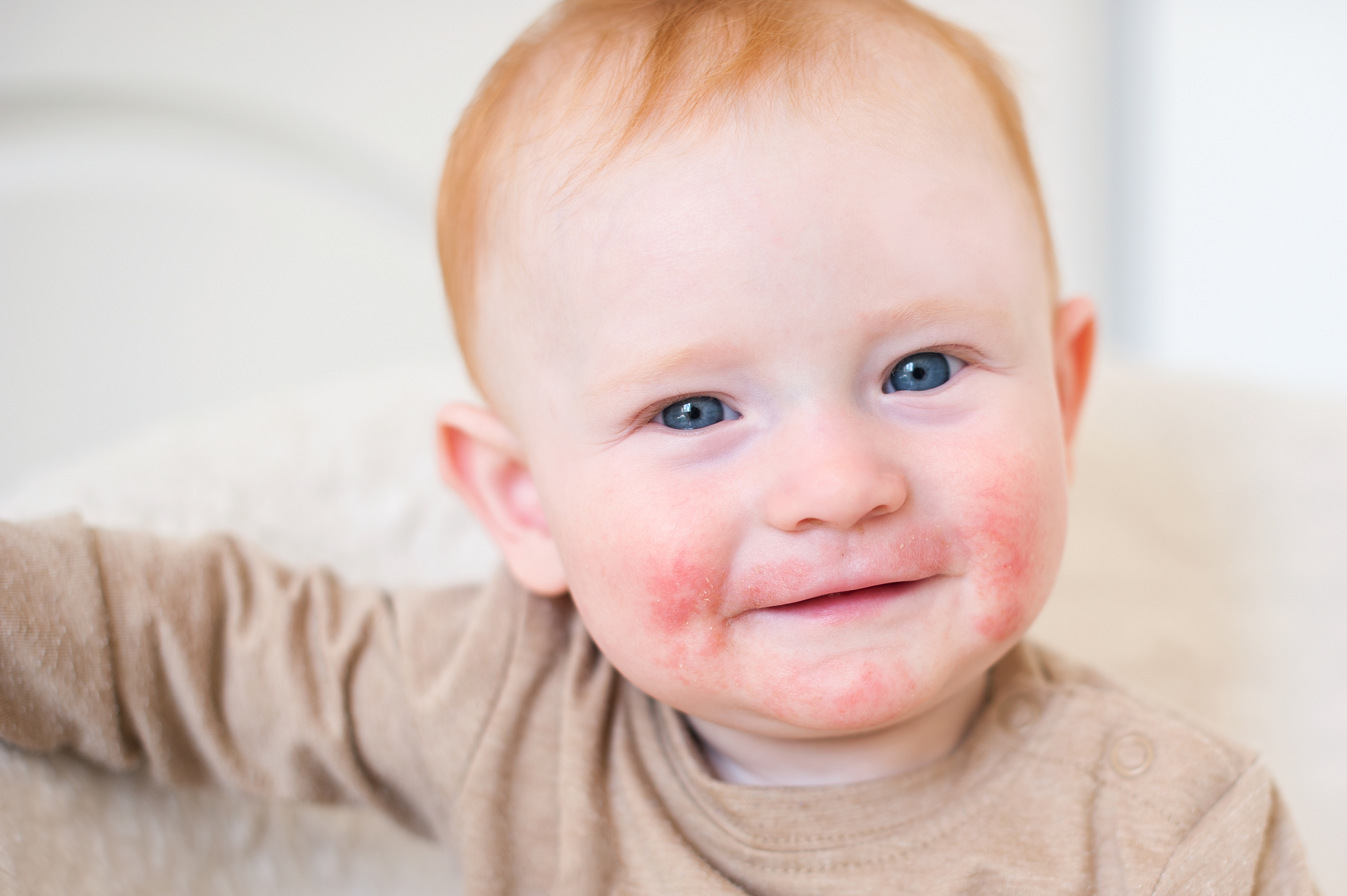 Am26 Pediatric Atopic Dermatitis