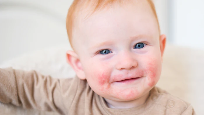Am26 Pediatric Atopic Dermatitis