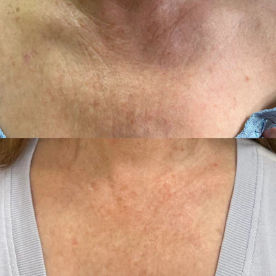 Before (top) and after synchronous ultrasound parallel beam technology to reduce wrinkles and tighten the skin.