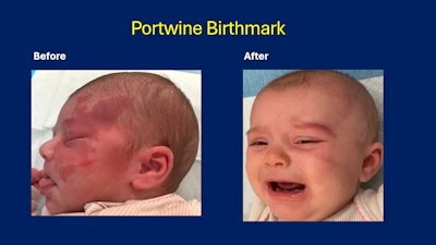 Before and after comparison of port-wine birthmark treatment on infant showing significant improvement in skin discoloration.