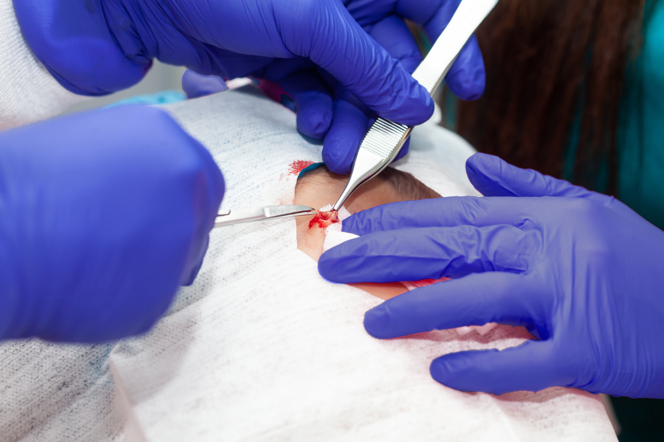 Ia26 Derm Surgery
