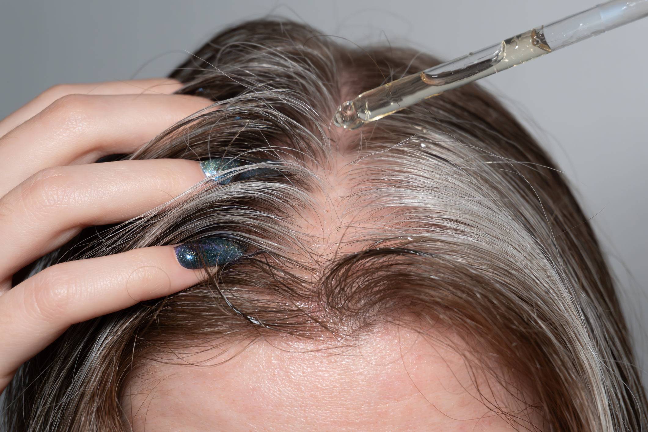 Ia26 Hair Disorders Minoxidil