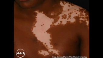 Clinical dermatology image showing depigmented patches on brown skin, courtesy of University of New Mexico Dermatology